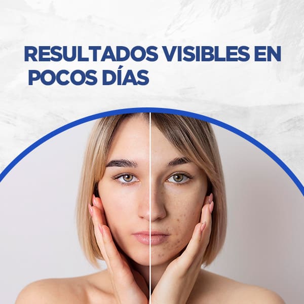 Elimina Verrugas con Verryclean+Envio Gratis